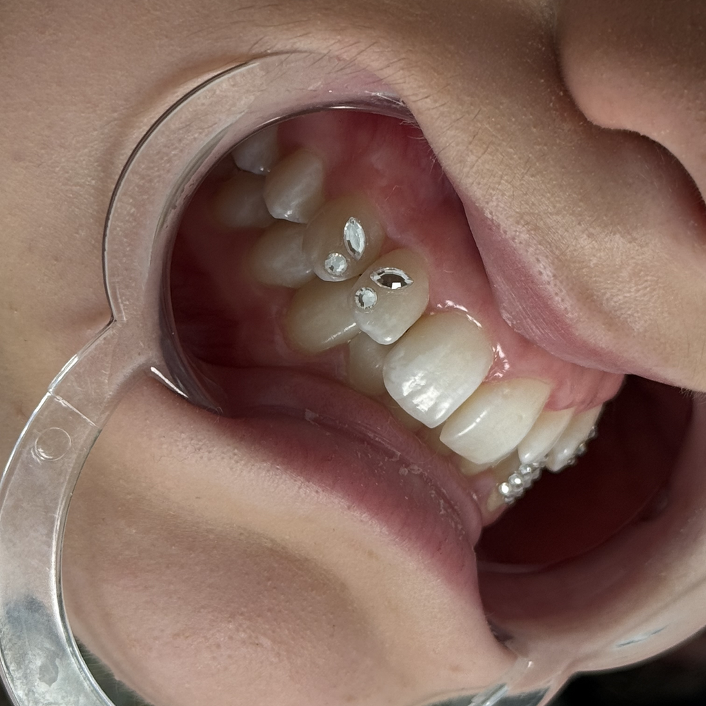 Cheek Retractor – BPA-Free Plastic Mouth Opener- 3-pack
